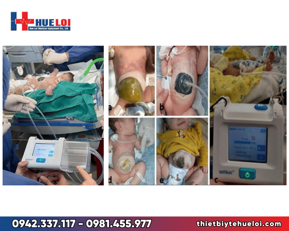 Máy điều trị vết thương hoại tử cao cấp - Vacuum Therapy RH-1000